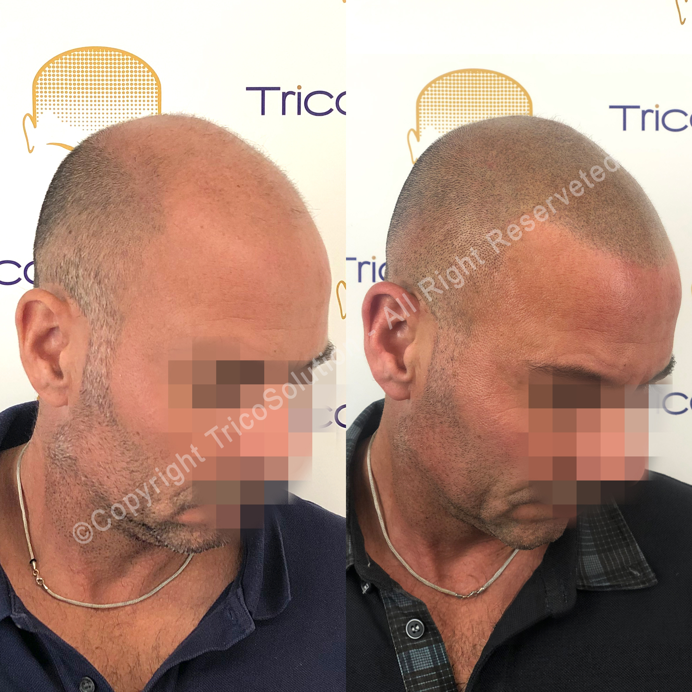Effetto Rasato โ TricoSolution
