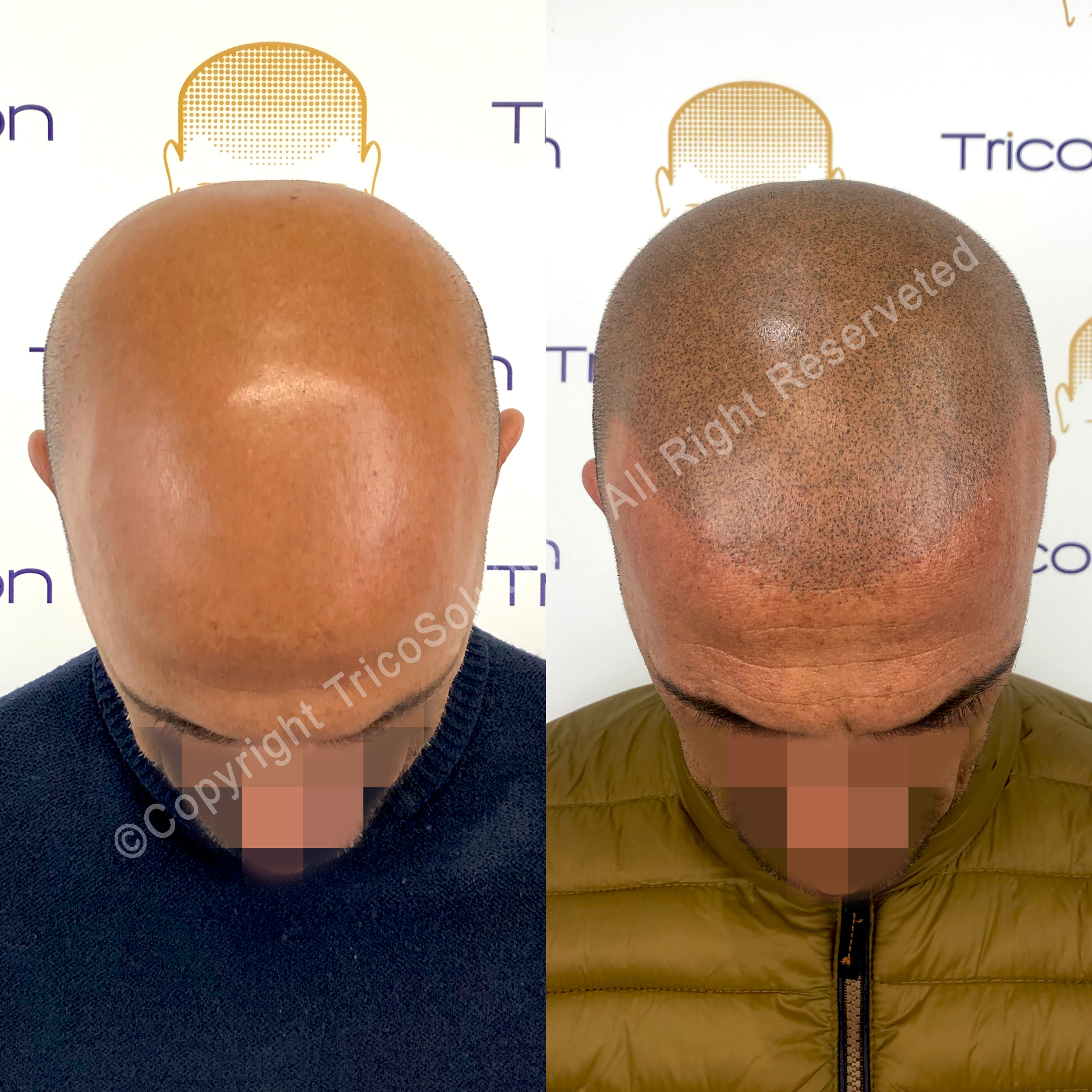 Effetto Rasato โ TricoSolution