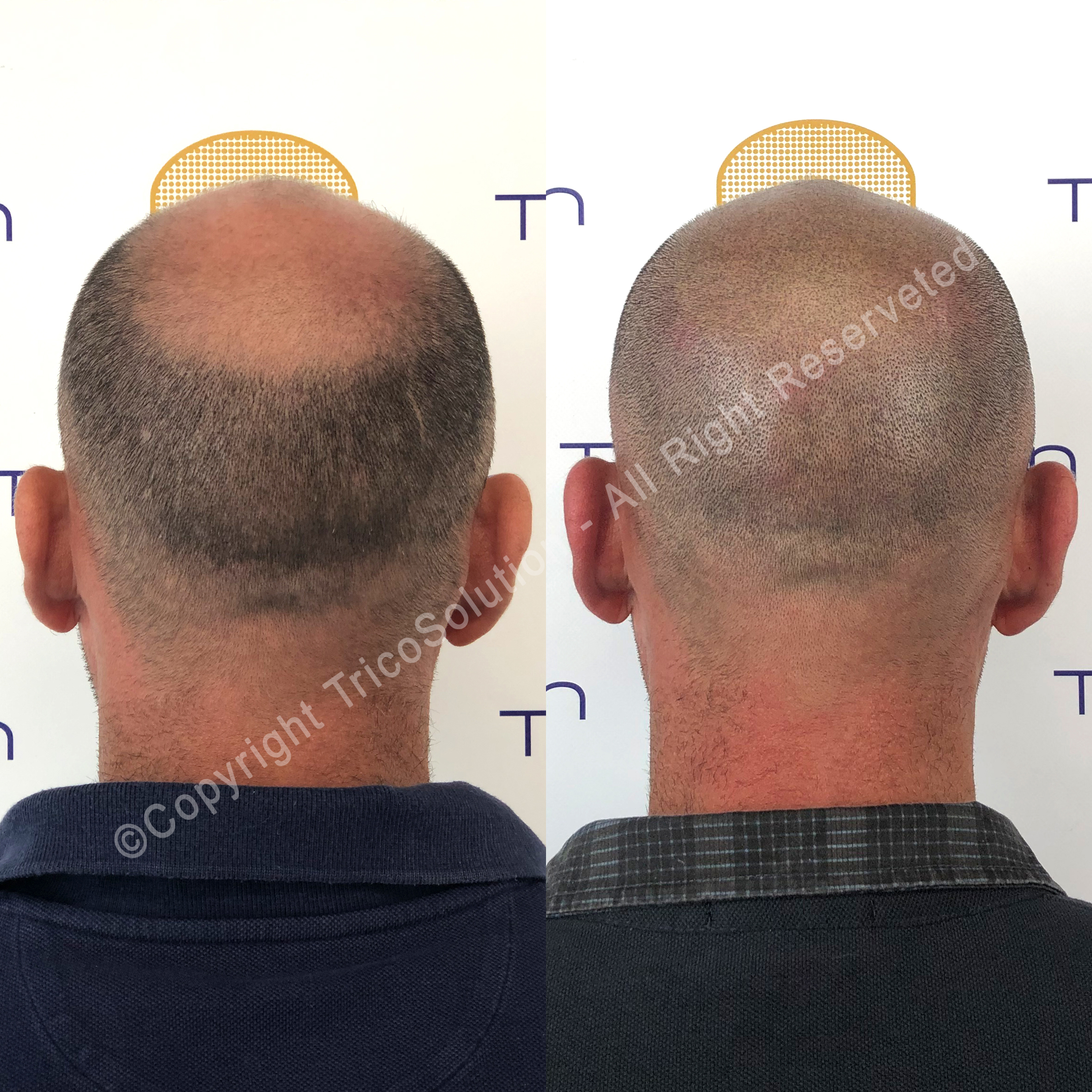 Effetto Rasato โ TricoSolution