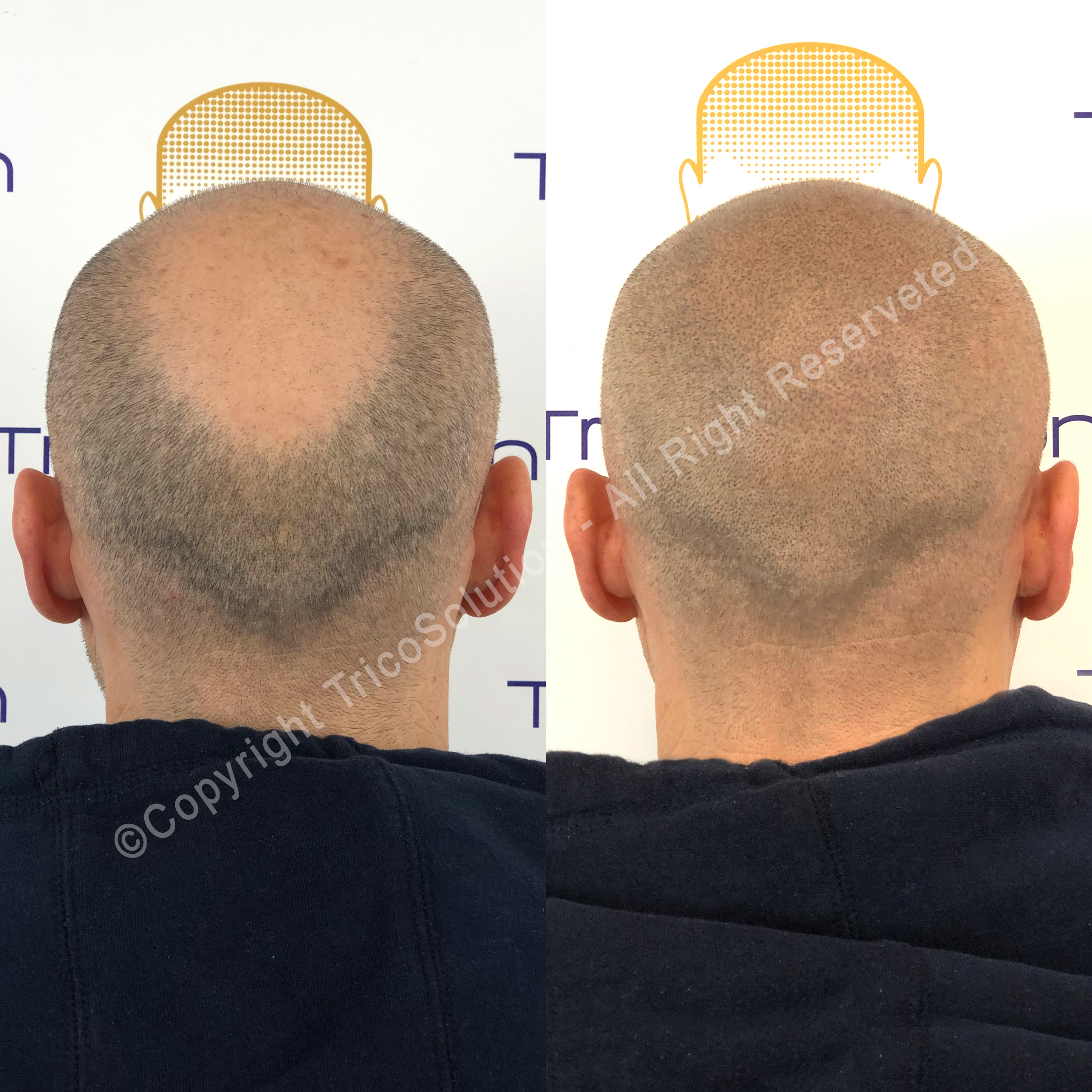 Effetto Rasato โ TricoSolution