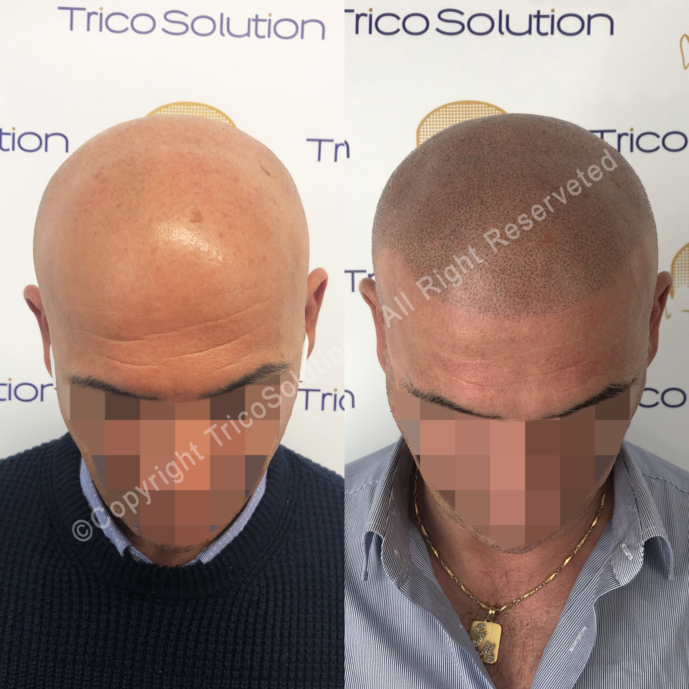 Effetto Rasato โ TricoSolution