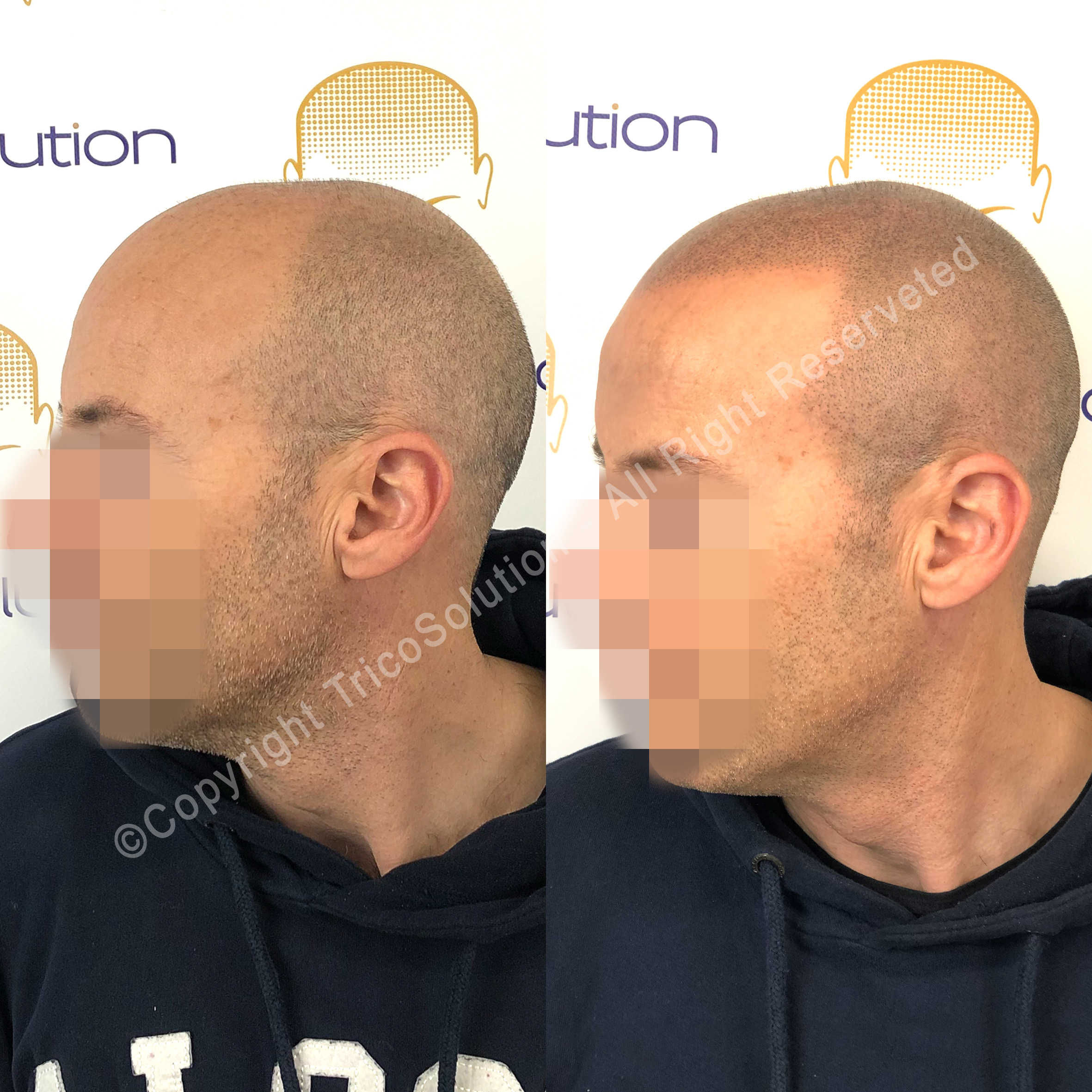 Effetto Rasato โ TricoSolution
