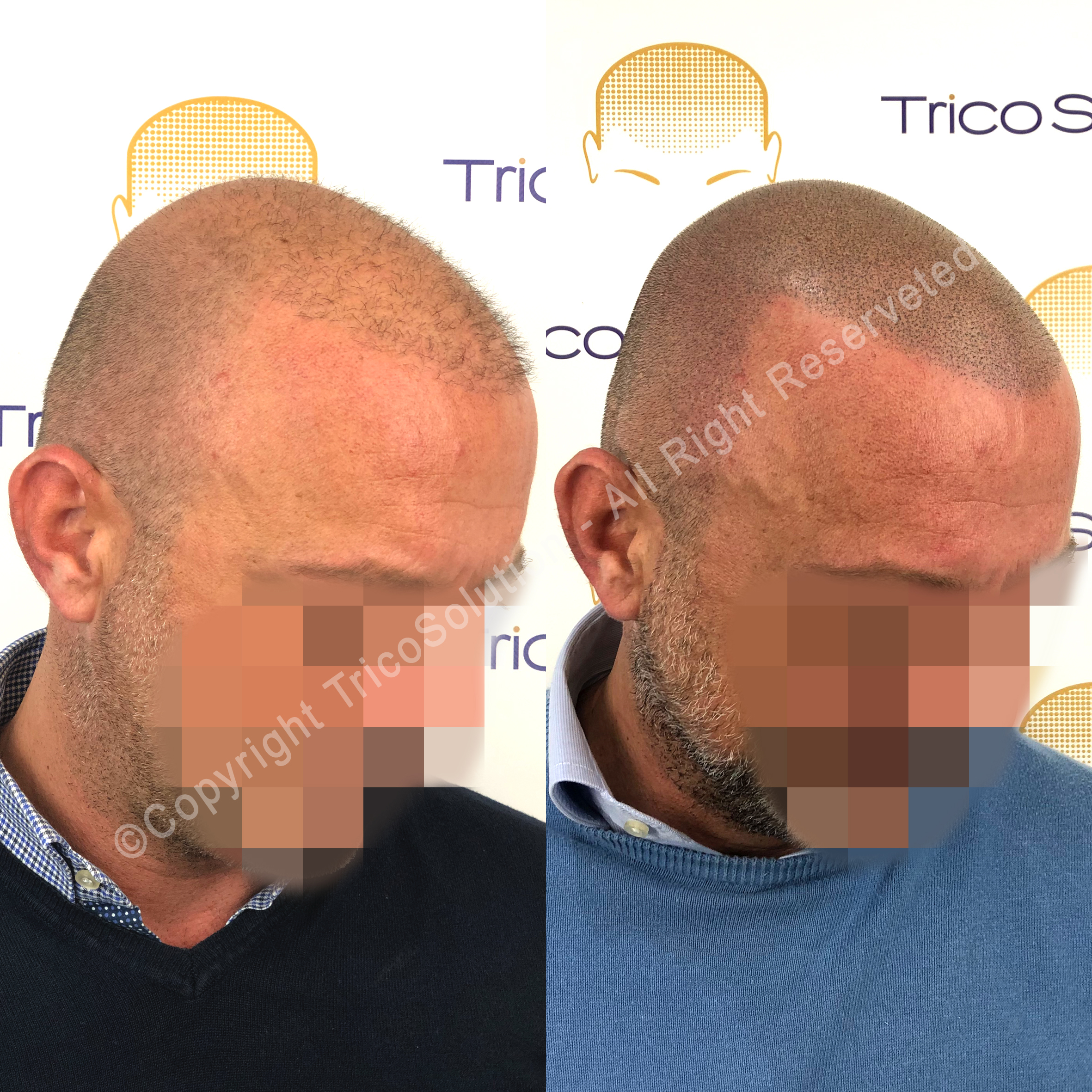 Effetto Rasato โ TricoSolution