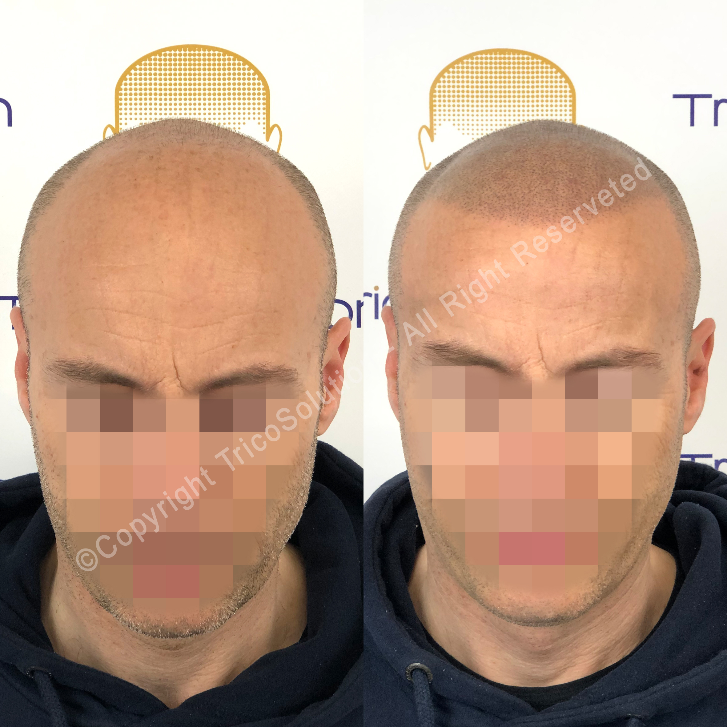 Effetto Rasato โ TricoSolution