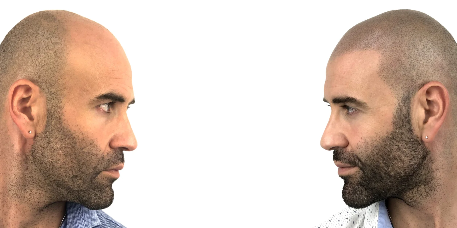 Tricopigmentazione effetto rasato: confronto di profilo prima e dopo il trattamento